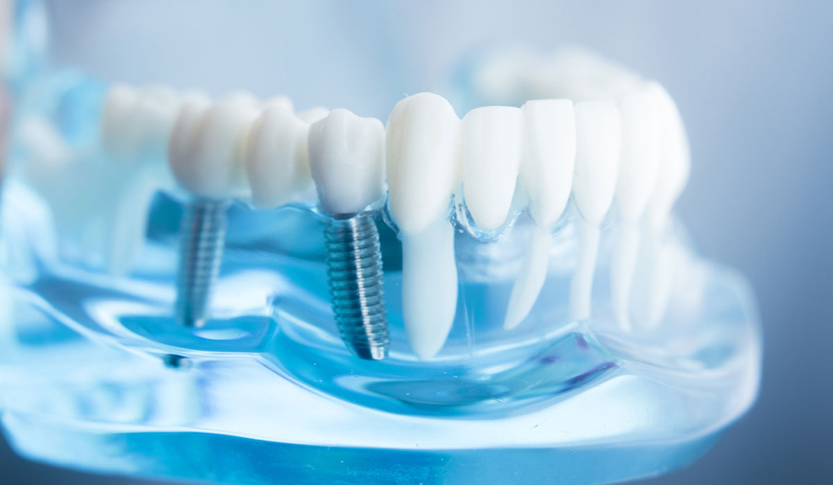 Pros and Cons of clear choice dental implants