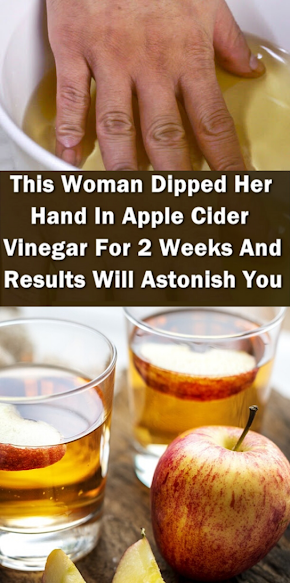 She Dipped Her Hand In Apple Cider Vinegar For 2 Weeks. When You Read You Will Do It Too!