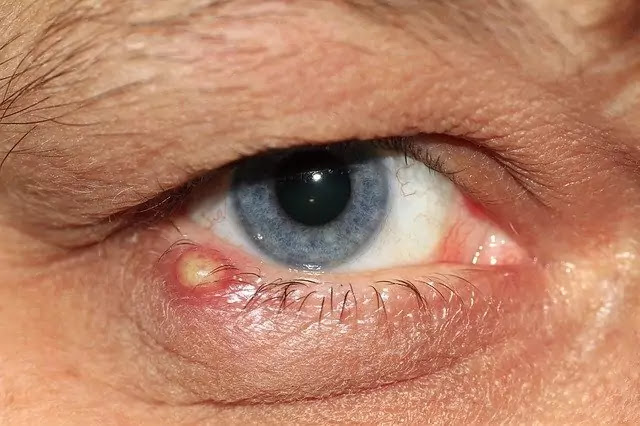 Can Styes Spread To Other Eye How Styes Are Caused qu-es-chalazi-n-y-orzuelo
