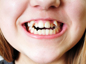 Răng mọc như thế nào gọi là răng thừa?