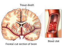 Tipe Penyakit Stroke