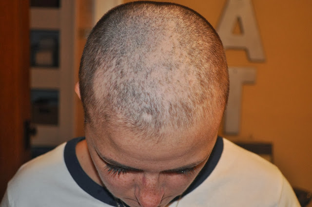 hair loss because of chemo, breast cancer, chemotherapy, pain