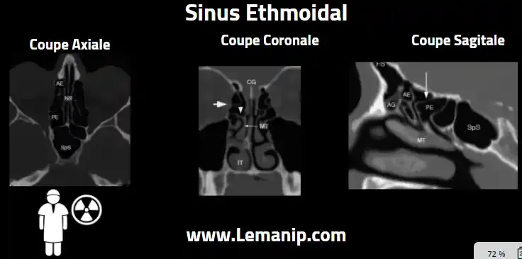 Anatomie Et Coupes Scanner Des Sinus Ethmoidal