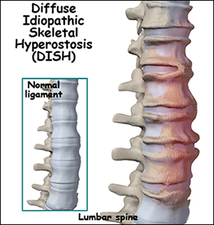 diffuse idiopathic skeletal hyperostosis, DISH