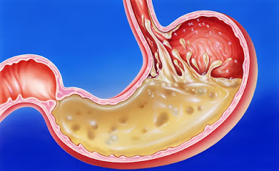 stomach acid reflux john bavosi أعراض حرقة المعدة و علاجها