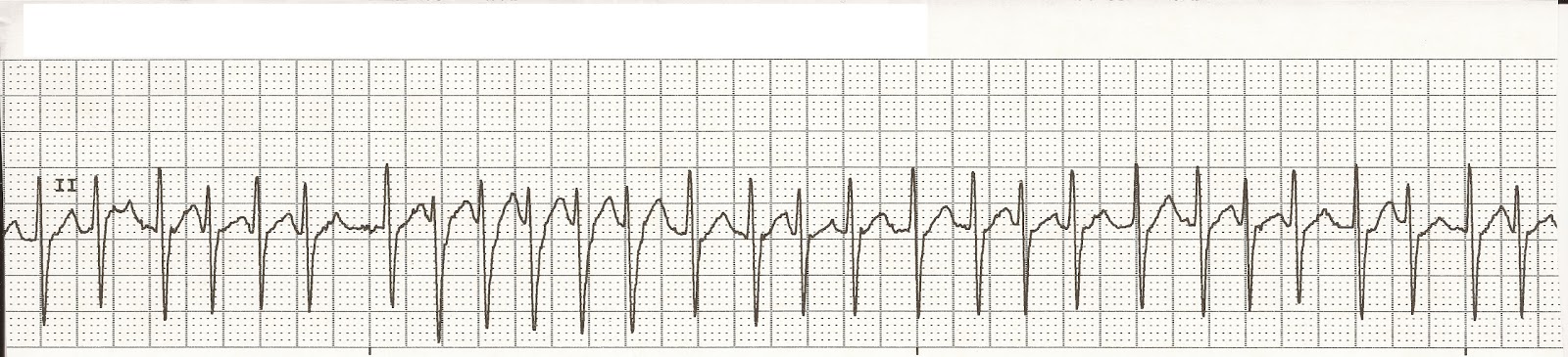 EKG Rhythm Strips 16: Atrial Rhythms