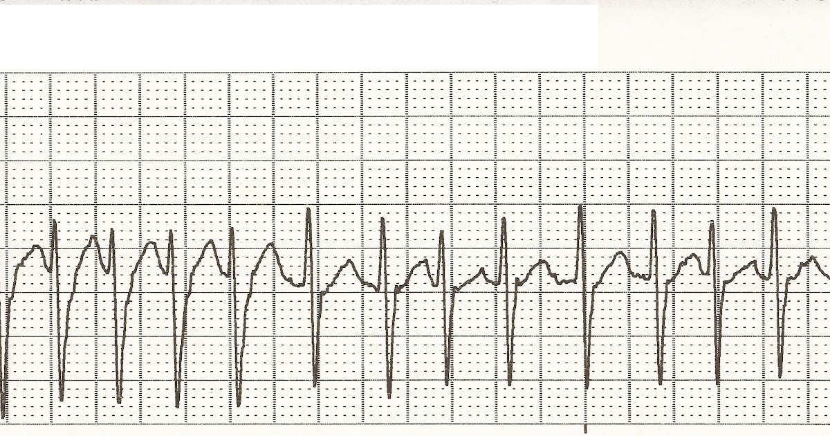 EKG Rhythm Strips 16: Atrial Rhythms