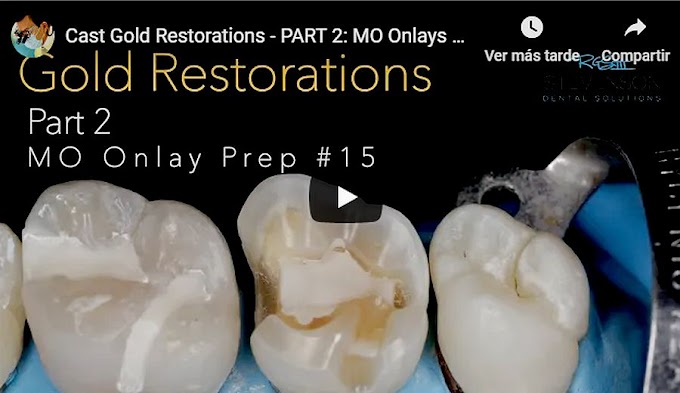 CAST GOLD Restorations - PART 2: MO Onlays Prep #15 -  Dr. Richard Stevenson