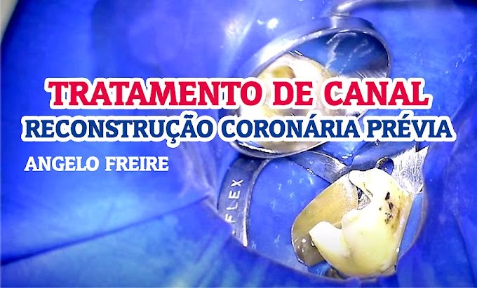 TRATAMENTO DE CANAL: Reconstrução coronária prévia - Angelo Freire