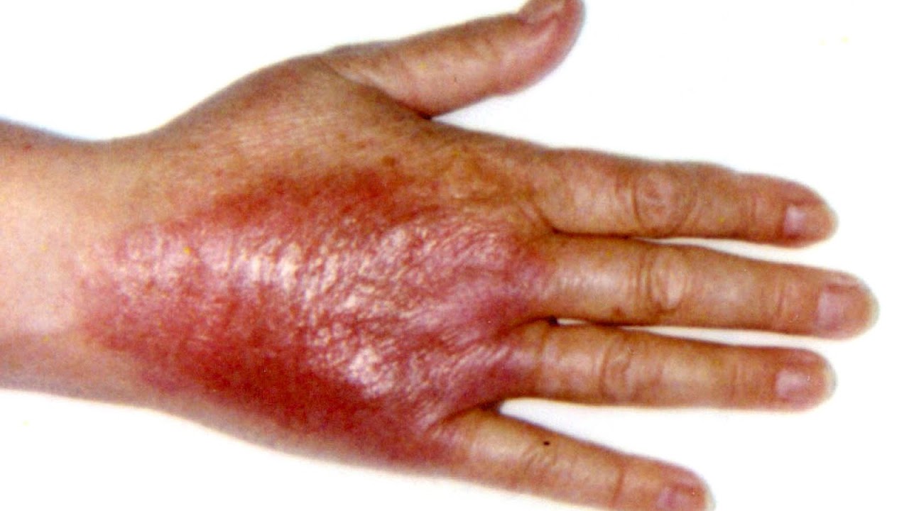 Extravasation (intravenous) Extravasation Injury Injury Choices