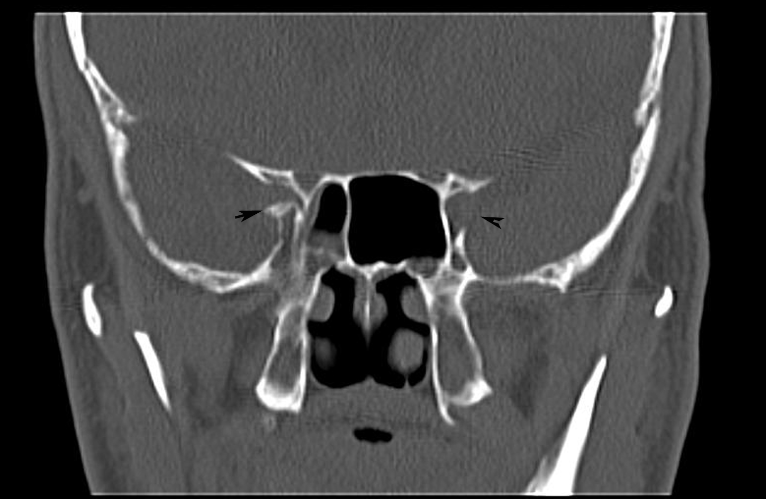 Radiodiagnosis Imaging is AmazingInteresting cases Traumatic optic