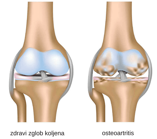 MSD medicinski priručnik za pacijente: Osteoartritis