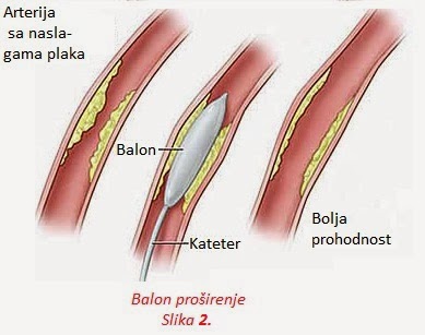 Баллонная ангиопластика нижних конечностей