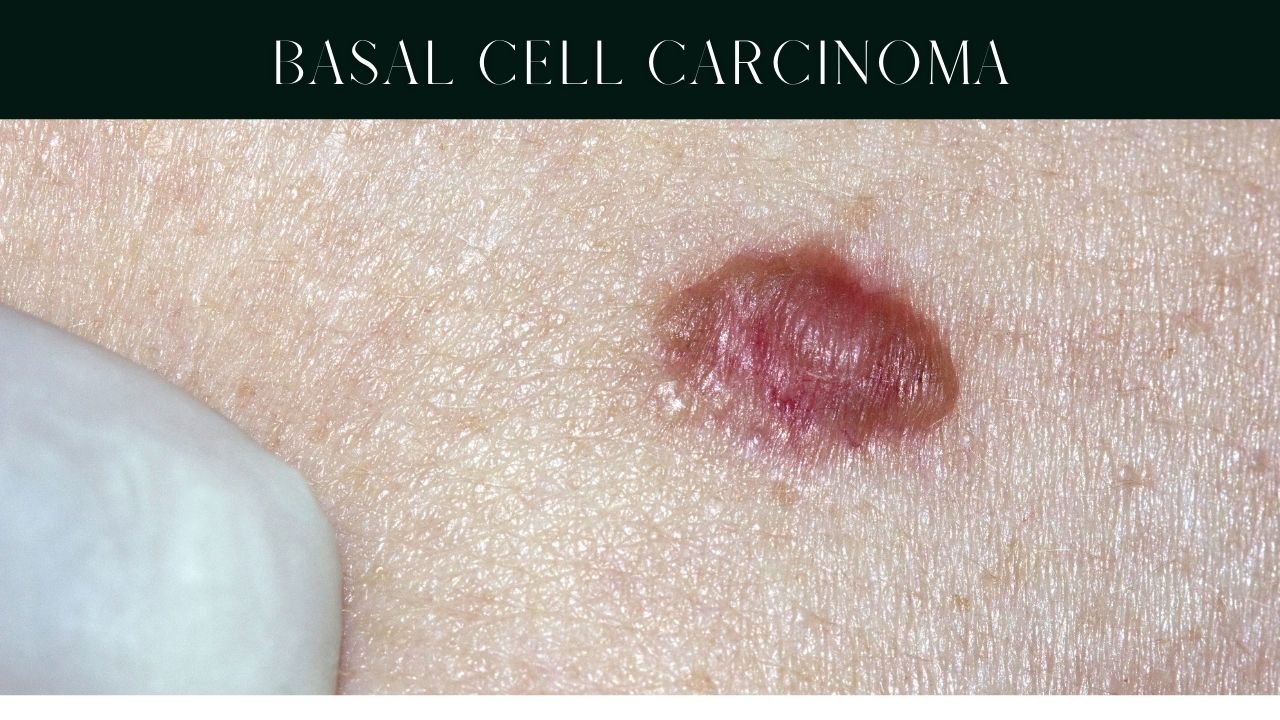 skin-cancer-types- causes-symptoms-pictures skin-cancer-types- causes-symptoms-pictures