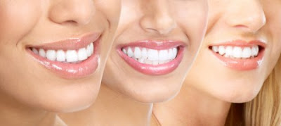 Cách làm trắng răng phổ biến hiện nay