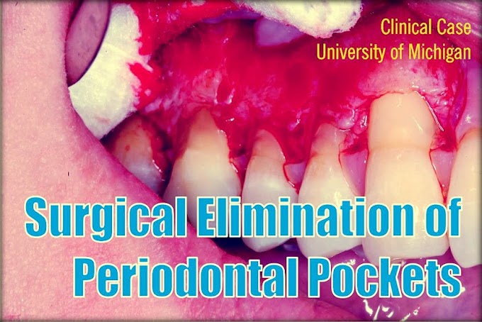 PERIODONTAL POCKETS: Surgical Elimination - University of Michigan