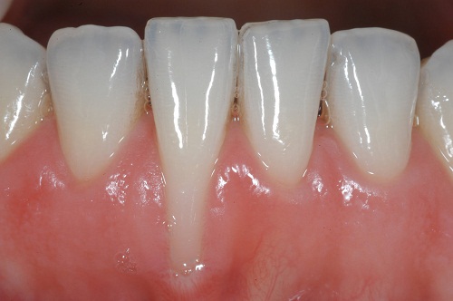 hiện tượng tụt lợi chân răng hiện tượng tụt lợi chân răng