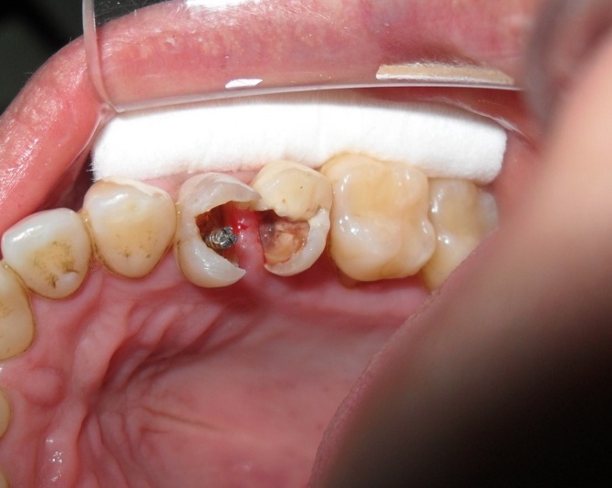 Cómo tratar las caries