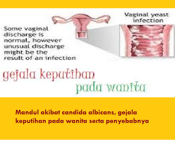 Mandul akibat candida albicans, gejala keputihan pada wanita serta