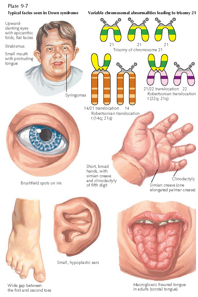 DOWN SYNDROME pediagenosis