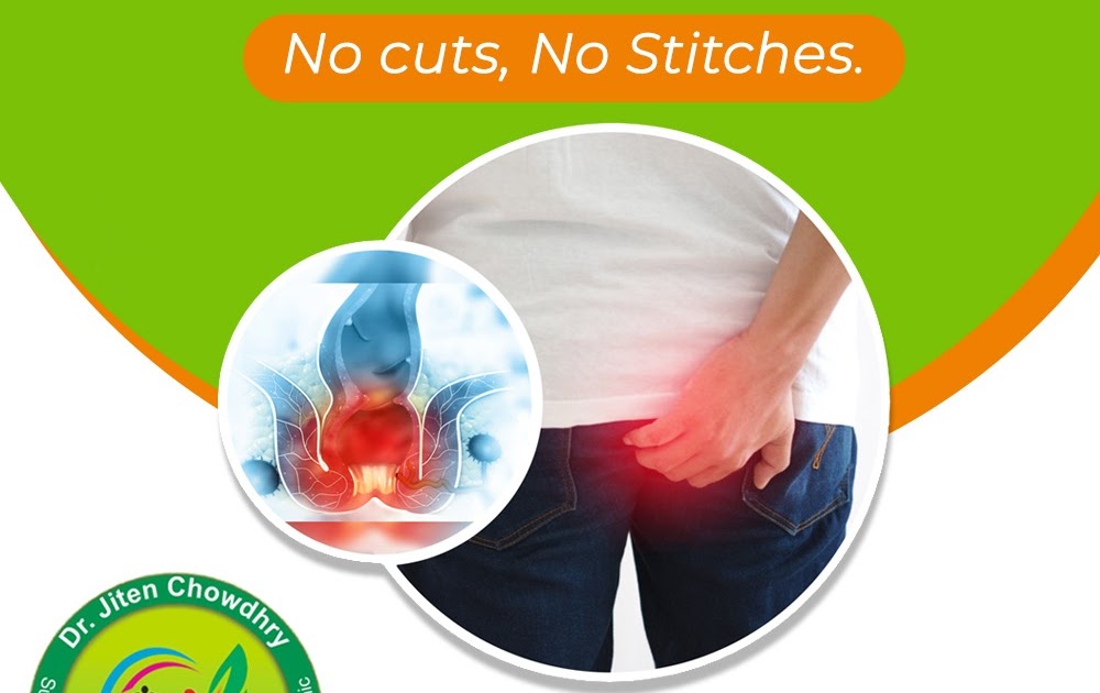 HOW PILES AND ITS SYMPTOMS CAN BE TREATED