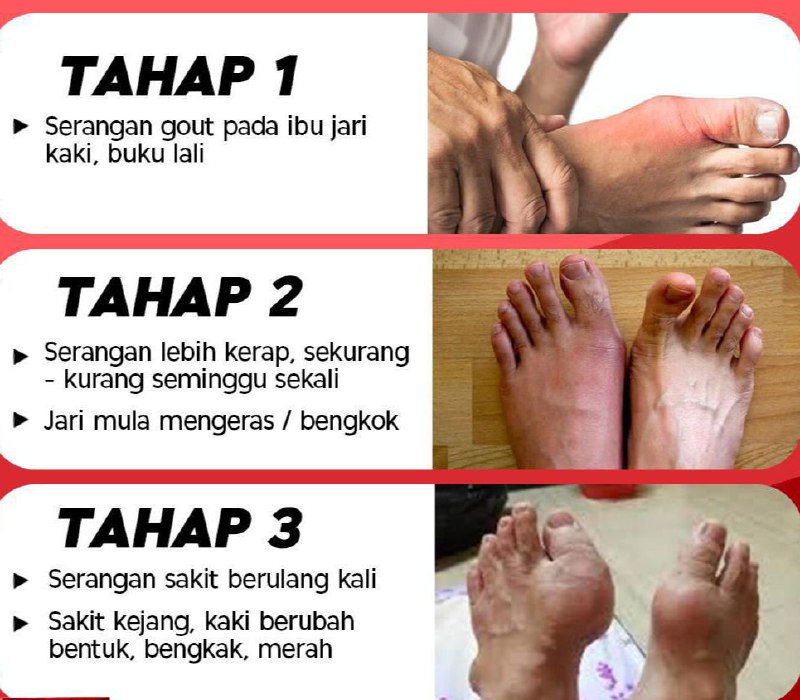 Punca gout kaki