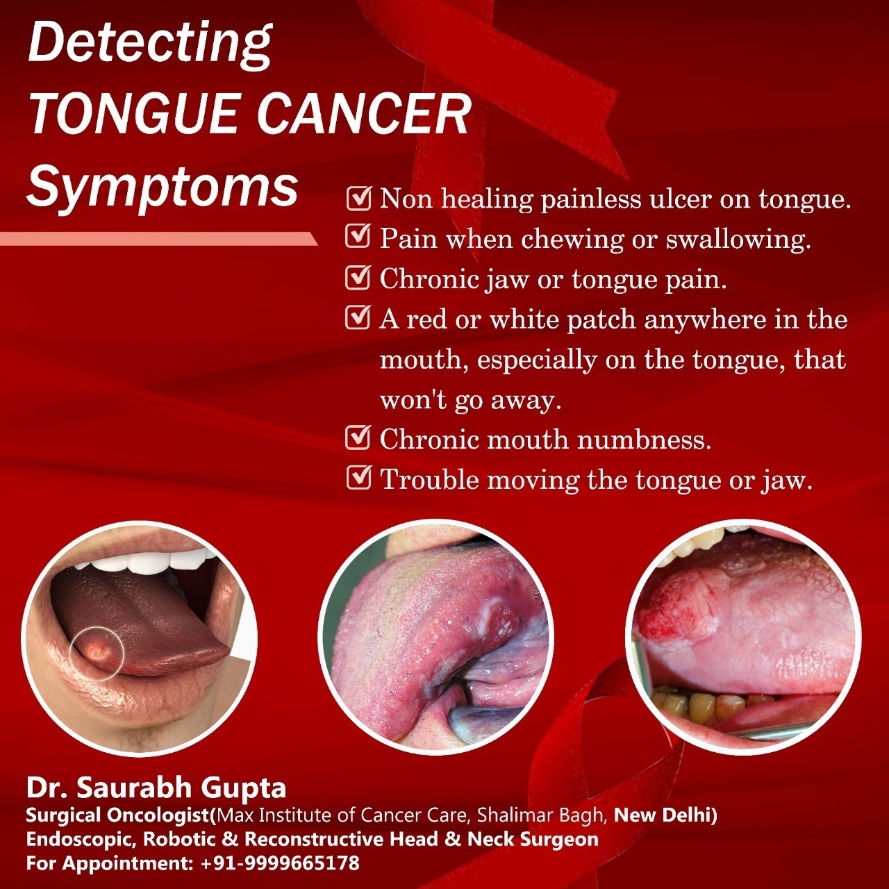 Cancer Lump On Tongue