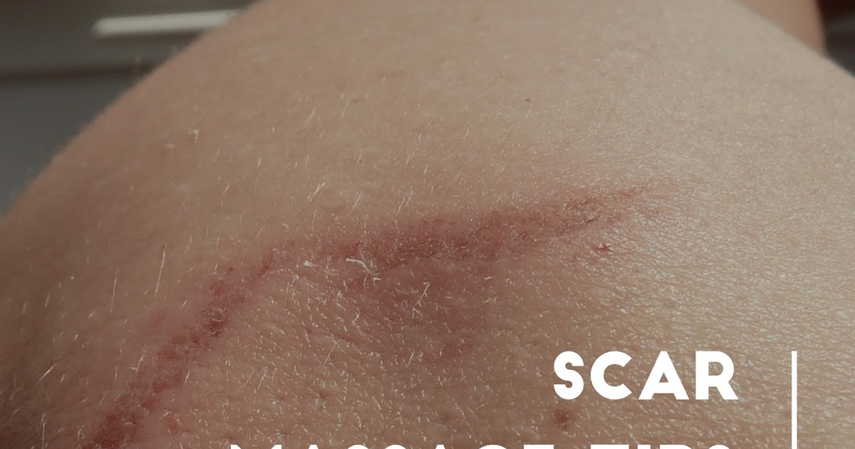 Manifesting Healing How to Massage Scars with Lymphedema