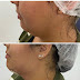  Lipoaspiração de papada: saiba tudo sobre o procedimento da harmonização facial 