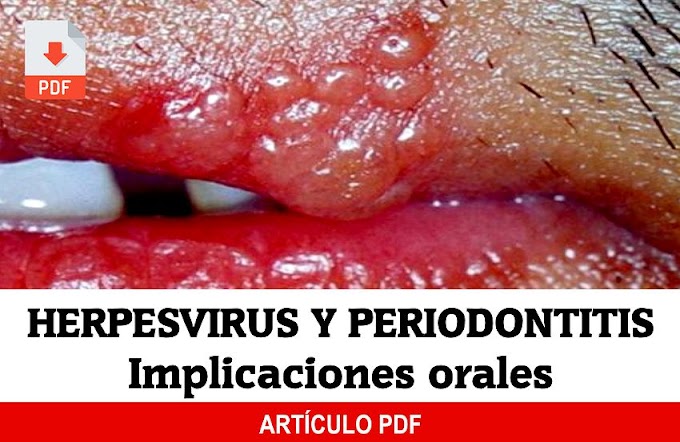 PDF: HERPESVIRUS, relación con la Enfermedad Periodontal e implicaciones orales