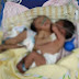 Fallecen siameses nacidos en el hospital de San Juan
