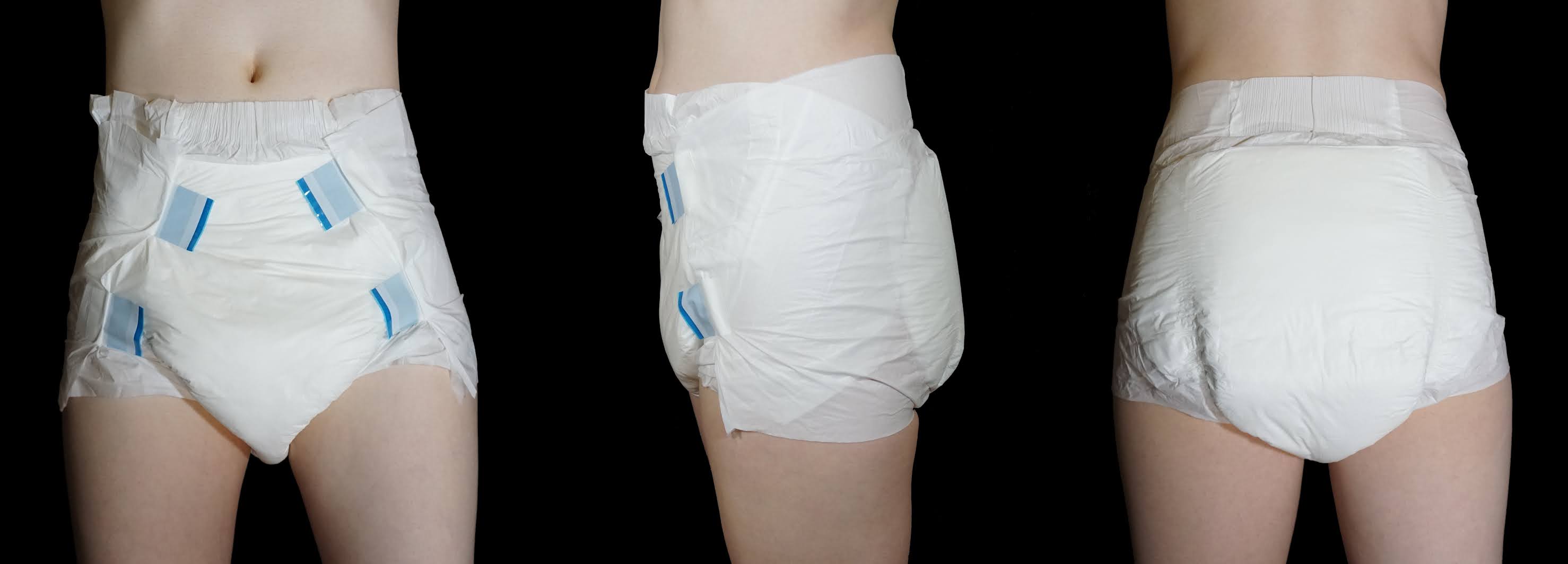 Adult diaper rash often occurs as a result of wearing adult diapers, incont...