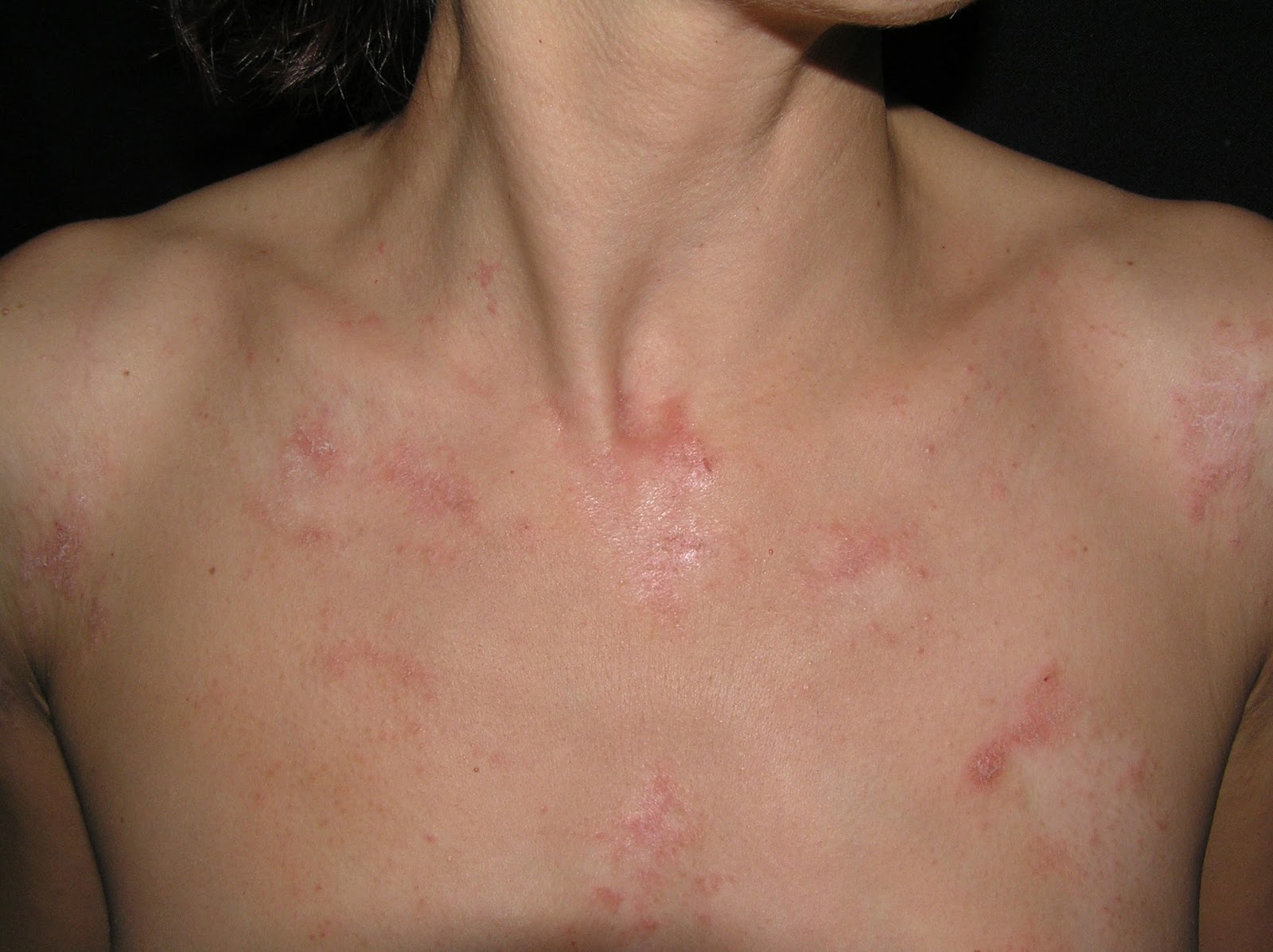 ¡Solución para la Dermatitis Atópica en Axilas!_2 Dermatitis atopica axilas_2