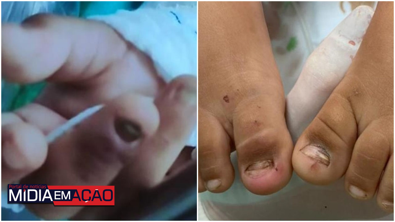 Menina de 2 anos é levada a hospital sem duas unhas e com lesões no intestino; Polícia suspeita de maus-tratos
