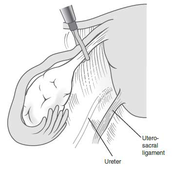 Laparoscopic Surgery of an Adnexal Mass