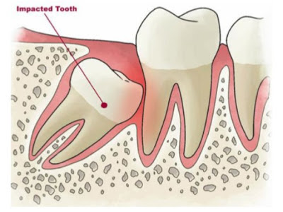 Răng khôn khi nào nên nhổ? Nhổ răng khôn có sao không? 1