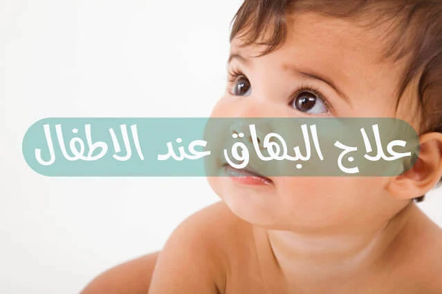 علاج البهاق عند الاطفال