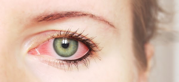 First Aid For People With Eye Injuries First Aid For People With Eye Injuries