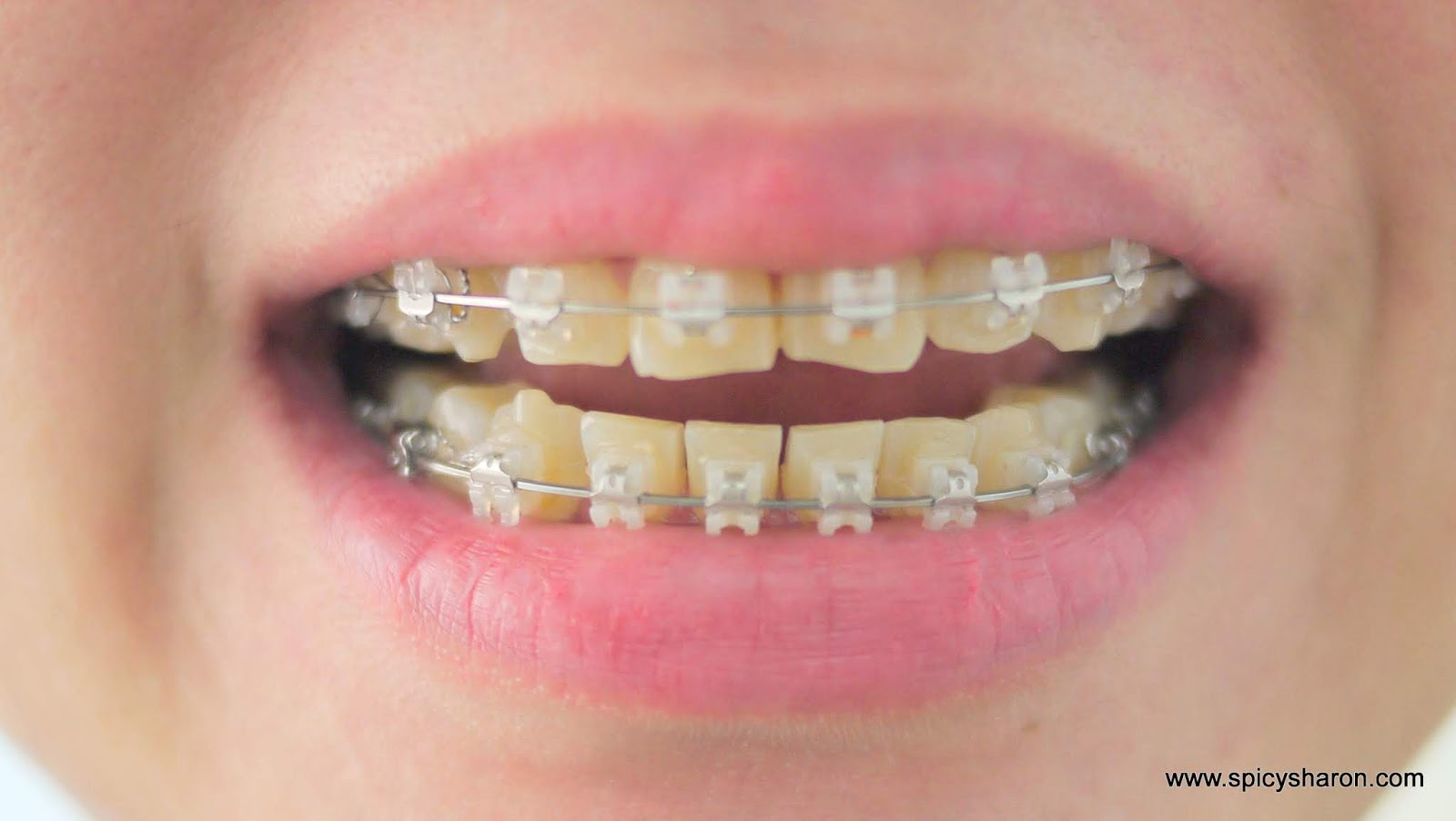 [Part 2] My Braces Journey with 32 Pearls Dental GLO Damansara