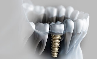 Những thông tin cơ bản về cấy ghép răng implant nha khoa