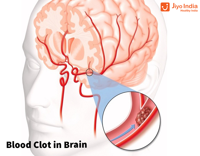 Blood Clot In Brain Causes, Symptoms, Treatment, And Lot More
