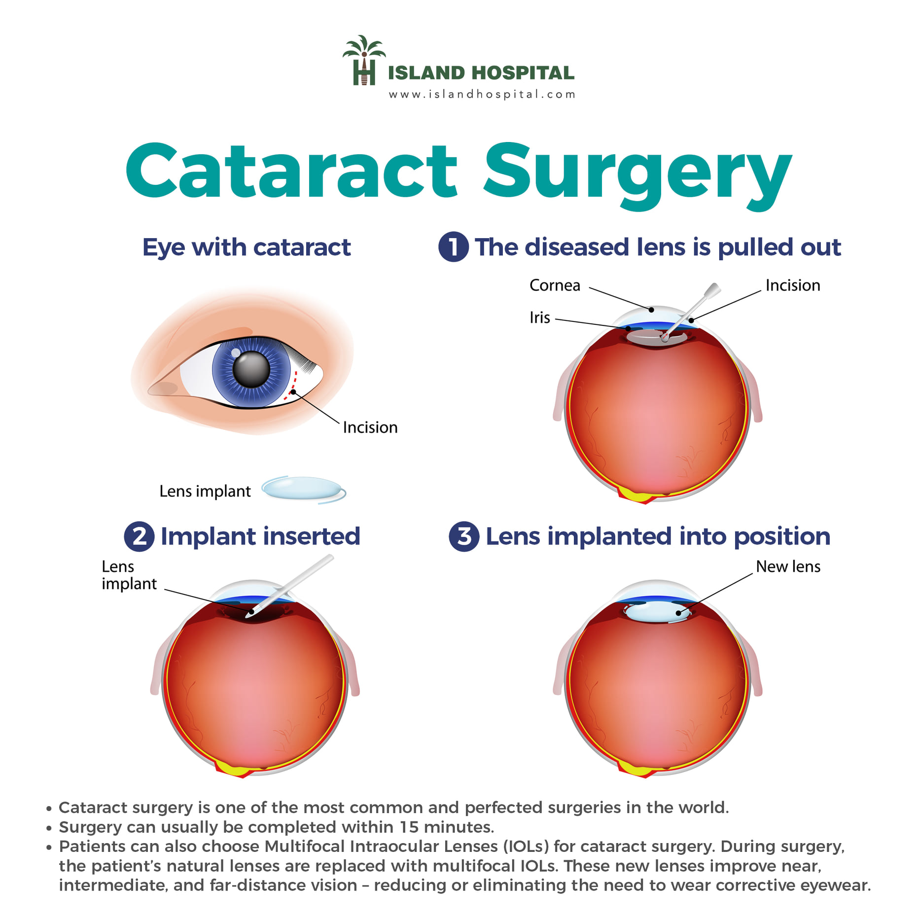 National Cancer Society of Malaysia, Penang Branch Cataract Facts