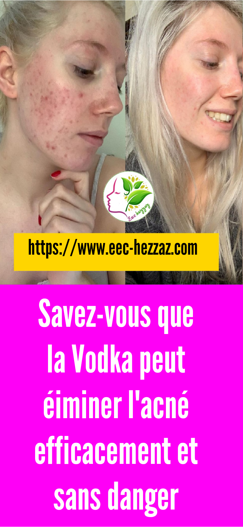 Savezvous que la Vodka peut éiminer l'acné efficacement et sans danger