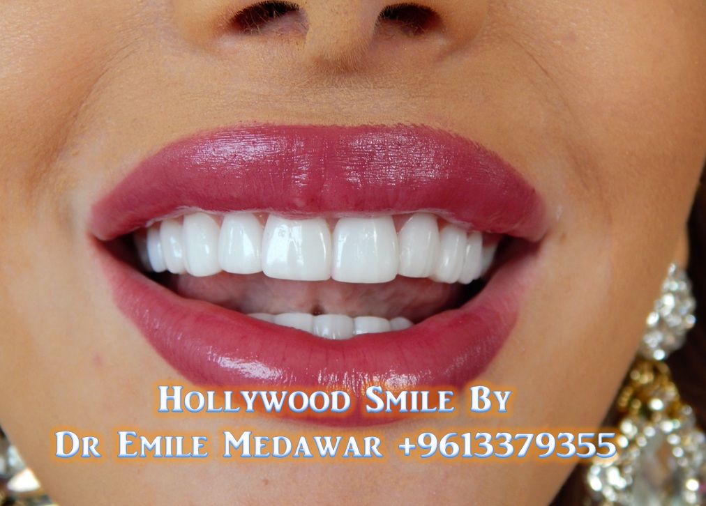 Veneers Lebanon, Best Quality, Best Price, Porcelain Veneers, Direct