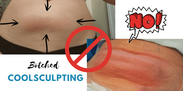 Botched Coolsculpting By Barbies Beauty Bits