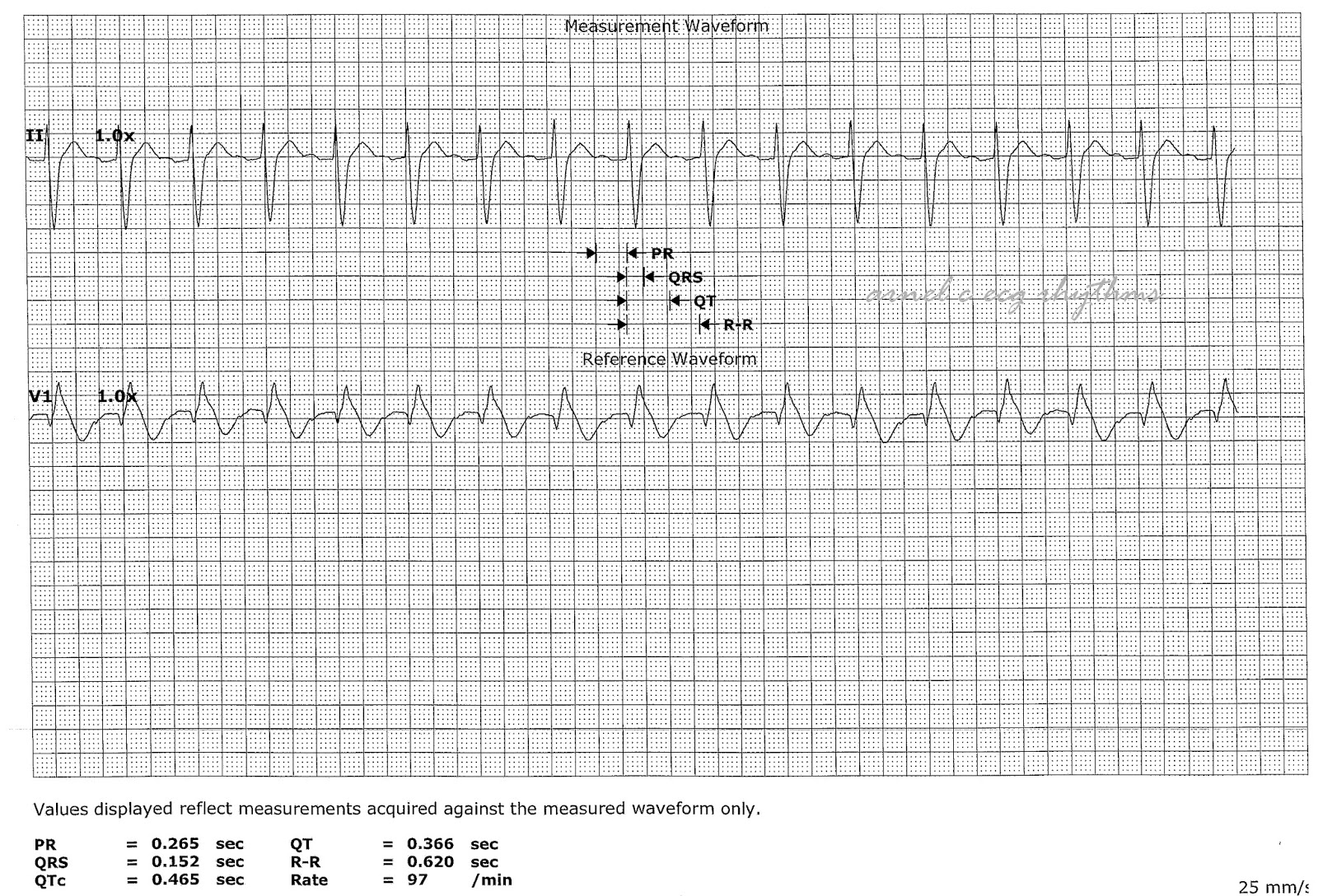 ECG Rhythms: Measurement Practice