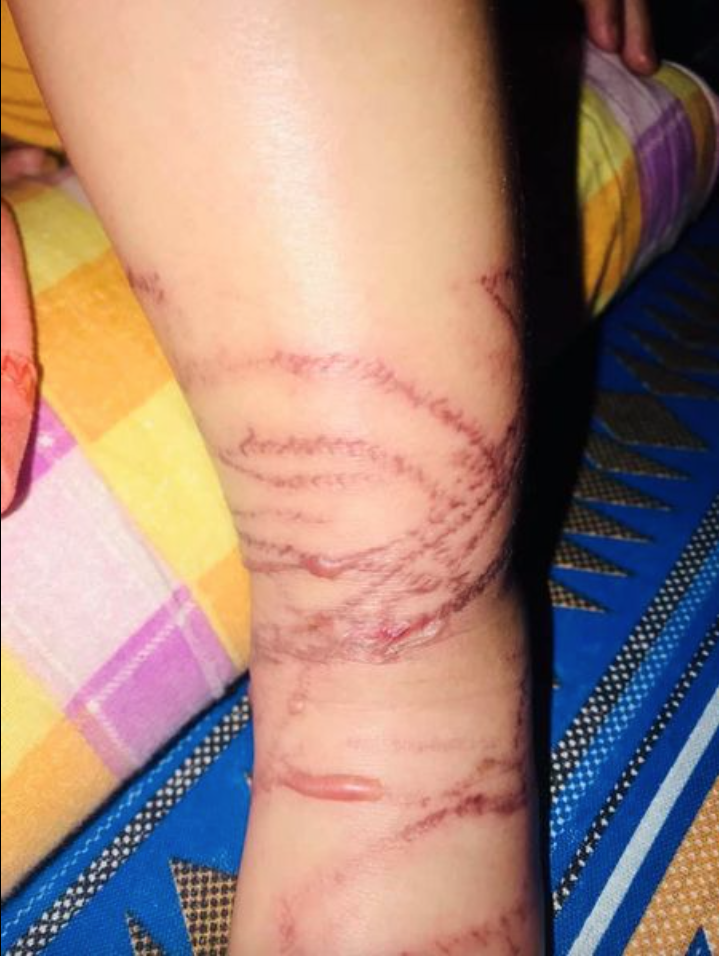 Child Barely Survives Philippines Box Jellyfish Sting