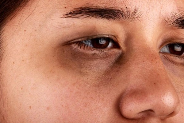 mengurangi lingkar hitam di bawah mata