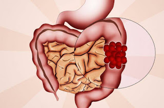 kanser hakkinda hersey blogger