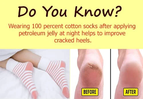How To Fix Cracked Heels Permanently Diy Cracked Heels
